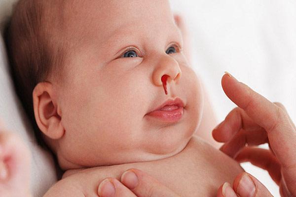 Rửa mũi không đúng cách khiến trẻ chảy máu mũi